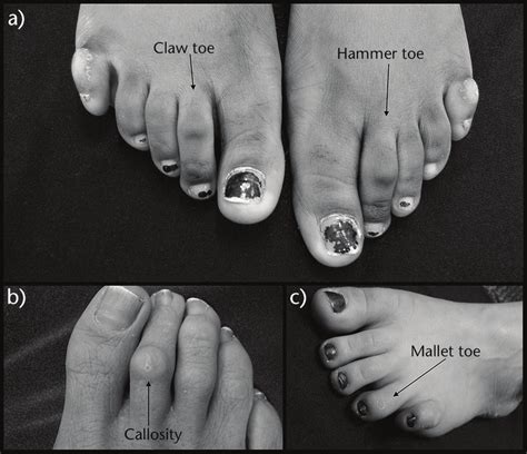 Common Deformities Seen In The Lesser Toes As Described In Table 2 A