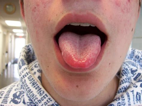 Blood Spots On Tongue