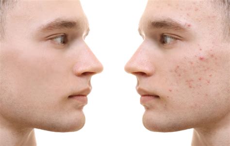 Natural Acne Treatments Reston Dermatology Cosmetic Center