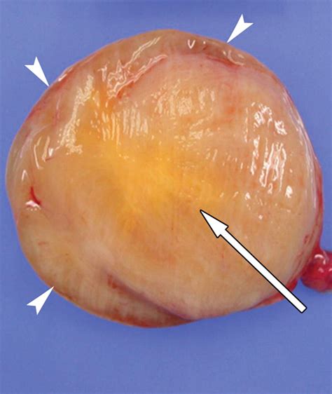 Imaging Of Primary Chest Wall Tumors With Radiologic Pathologic