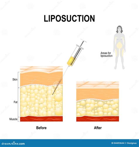 Human Skin Layer Before And After Liposuction Stock Vector