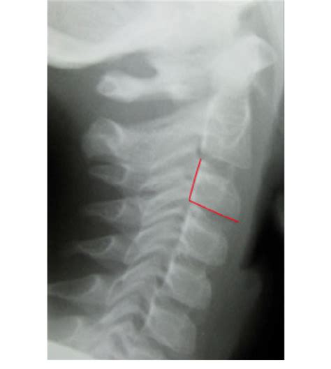 Lateral Cephalometric Radiograph Of Cervical Spine Of A Person In