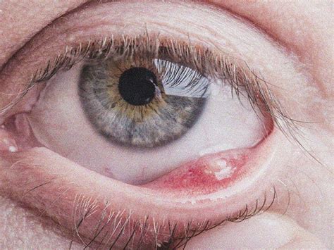 Eyelid Bump Symptoms Causes And Treatments