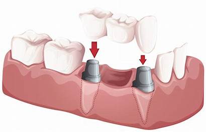 Dental Bridge Prosthesis Implants Fixed Partial Implant