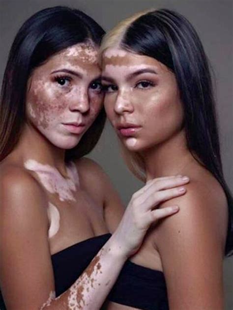 This Model Is Showcasing Her Vitiligo For A Great Cause Allure