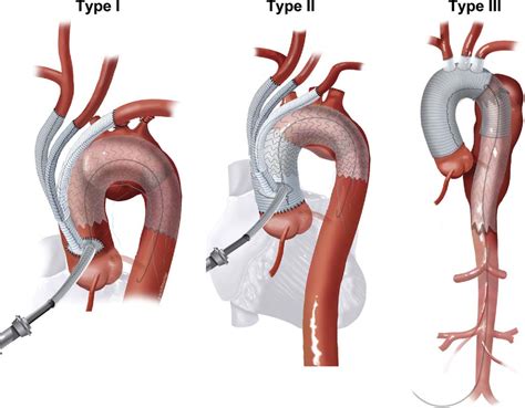 Successful Hybrid Zone Landing Thoracic Endovascular Aortic Repair My