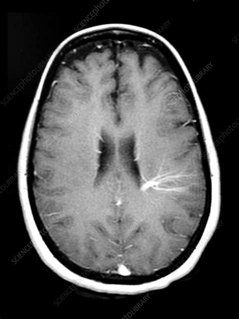 Cerebral Developmental Venous Anomaly Dva Stock Image C0430155