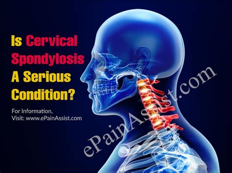 Is Cervical Spondylosis A Serious Condition And How Can It Be Treated