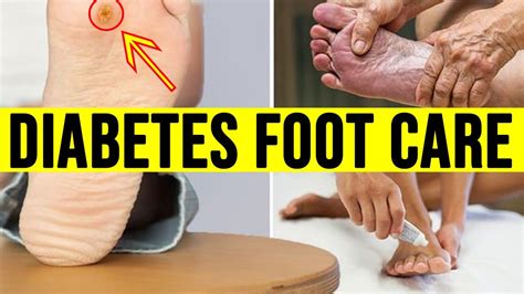Diabetes Foot Care 10 Foot Care Tips To Protect Yourself Youtube