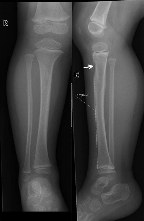 The Anterior Tilt Angle Of The Proximal Tibia Epiphyseal Plate A