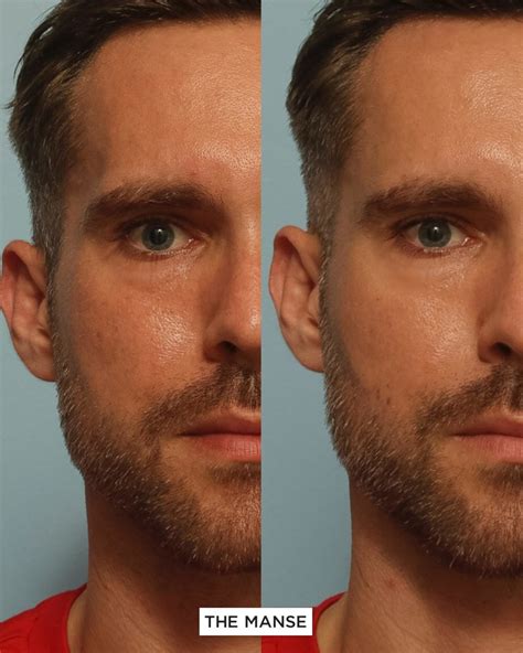 Fillers And Threadlift For A Male Natural Results Best Clinic Sydney