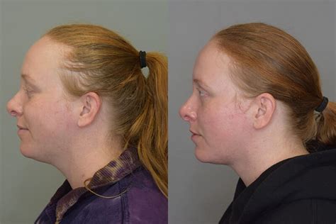 Chin And Jawline Lipo Beverly Hills Before And After