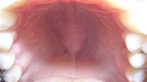 bump on roof of mouth renew physical therapy