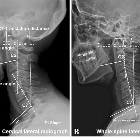 Pdf Does Whole Spine Lateral Radiograph With Clavicle Positioning