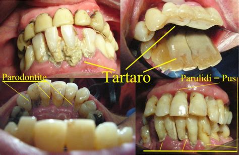 Parodontite Nozioni Di Etiopatogenesi Clinica Diagnosi