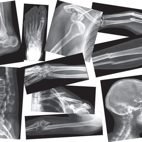 Broken Bones X Rays Broken Bone Human Bones X Ray