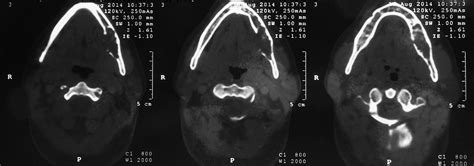 Odontogenic Myxoma With Diffuse Calcifications A Case Report And