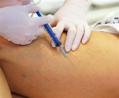 Sclerotherapy For Spider Veins Dallas Spider Vein Treatment