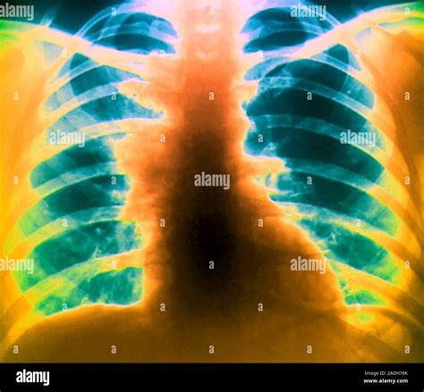 Adenopatía Mediastinal Frontal De Color Radiografía De Tórax De Un