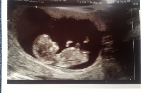 Down Syndrome Baby Ultrasound 12 Weeks 12 Weeks A Second Peek Inside