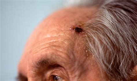 Skin Cancer Spread Stopped Disease Treated With Breakthrough Drug