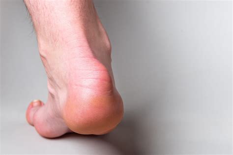 Do You Have Haglunds Deformity River Podiatry I The Best Foot And Ankle Care In Ny Nj