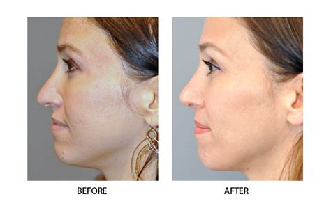 Rhinoplasty The Ultimate Guide By An Expert Boston Surgeon