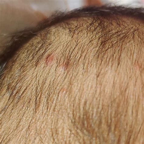 Hi My Baby Boy 35 Month Oldhe Has Small Pimple On Head Please See The