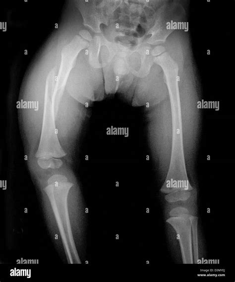 X Ray Showing A Femur Fracture In A 3 Year Old Boy A Victim Of Child