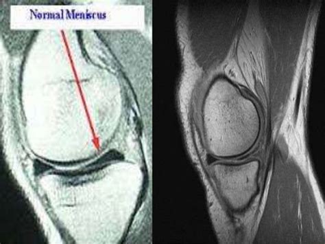Soft Tissue Injury Of The Knee