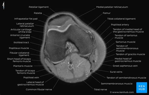 How To Read The Normal Knee Mri Kenhub