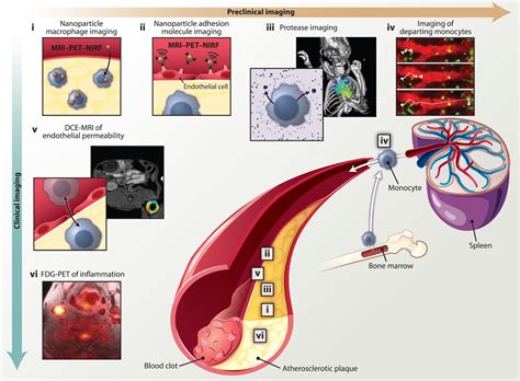 Imaging And Nanomedicine In Inflammatory Atherosclerosis Science