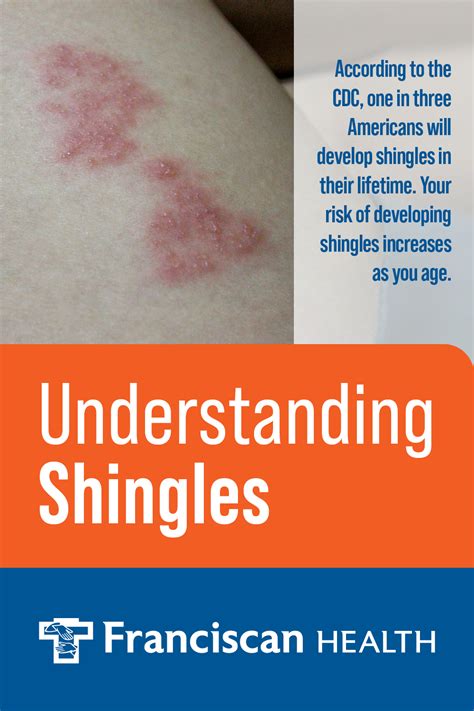 Shingles Symptoms And Prevention Franciscan Health