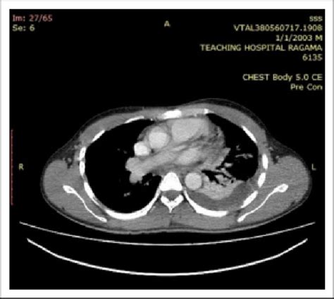 Contrast Enhanced Computed Tomography Scan Cect Lower Chest