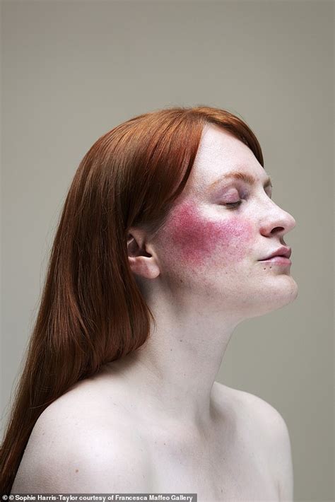 Women With Skin Conditions Like Acne Eczema And Rosacea Pose Make Up