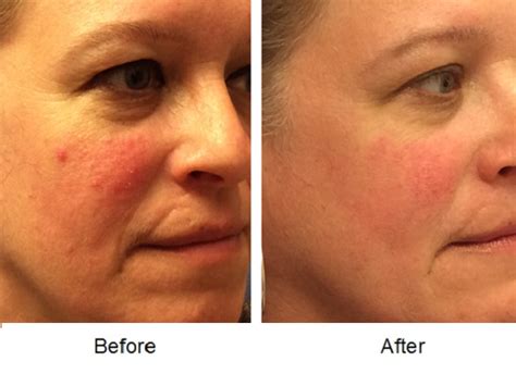 Ipl Light Treatment Before And After Photos Lisa Bunin Md