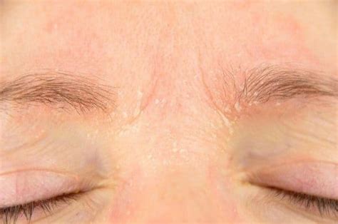 Dandruff In Eyebrows Dry Skin Get Rid Remove Naturally Home