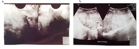 figure 3 from cervical elongation caused by big cervical fibroid resembling malignant cervical