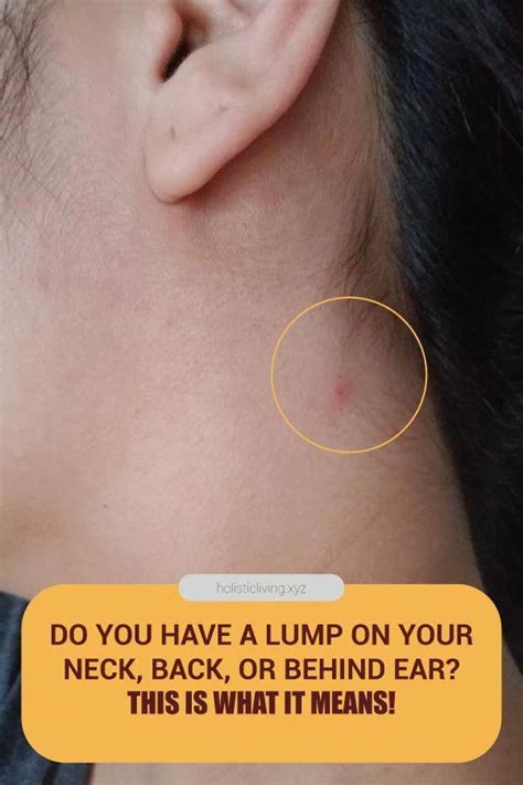 Do Youve Got A Lump On Your Neck Back Or Behind Your Ear This