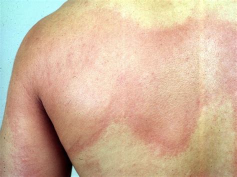 Xolair For The Treatment Of Chronic Hives
