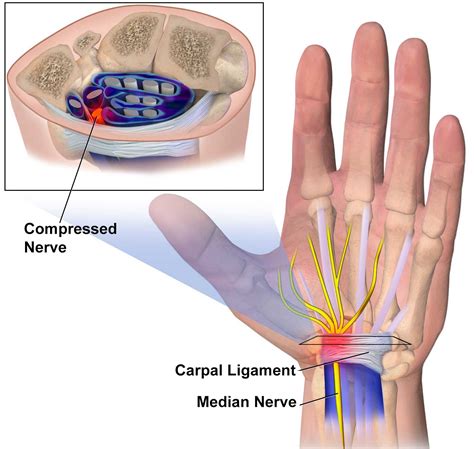 Carpal Tunnel Syndrome Diagnosis Therapy Dr Scott Naftulin