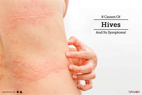 Causes Of Hives And Its Symptoms By Dr Archit Aggarwal Lybrate