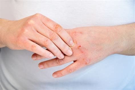 Contact Dermatitis Causes Treatment And Symptoms