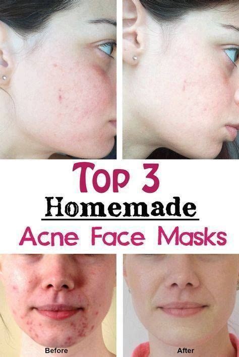 5 Homemade Acne Face Masks With All Natural Ingredients Face Acne