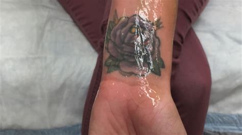 Gang Tattoo Removal Program Expands To Help Human Trafficking Victims