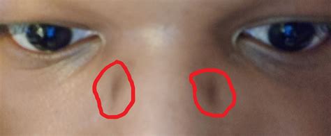[skin concerns] how do i get rid of these dark spots that my glasses nosepads seemingly caused