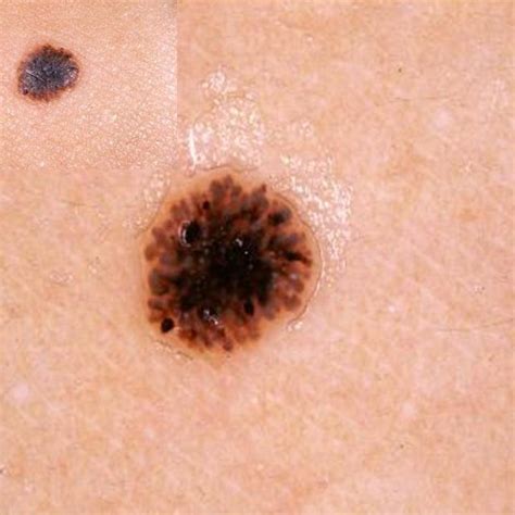 Clinical And Dermoscopic Typical Features Of Pigmented Spitz Nevus