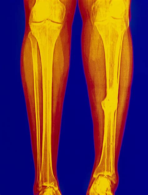 Coloured X Ray Of Fractured Shin Bone Tibia Photograph By Mehau Kulyk