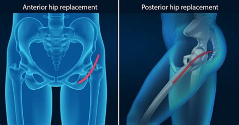 Is Anterior Hip Replacement Better