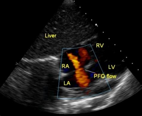 Patent Foramen Ovale Vs Small Asd Cardiophile Md